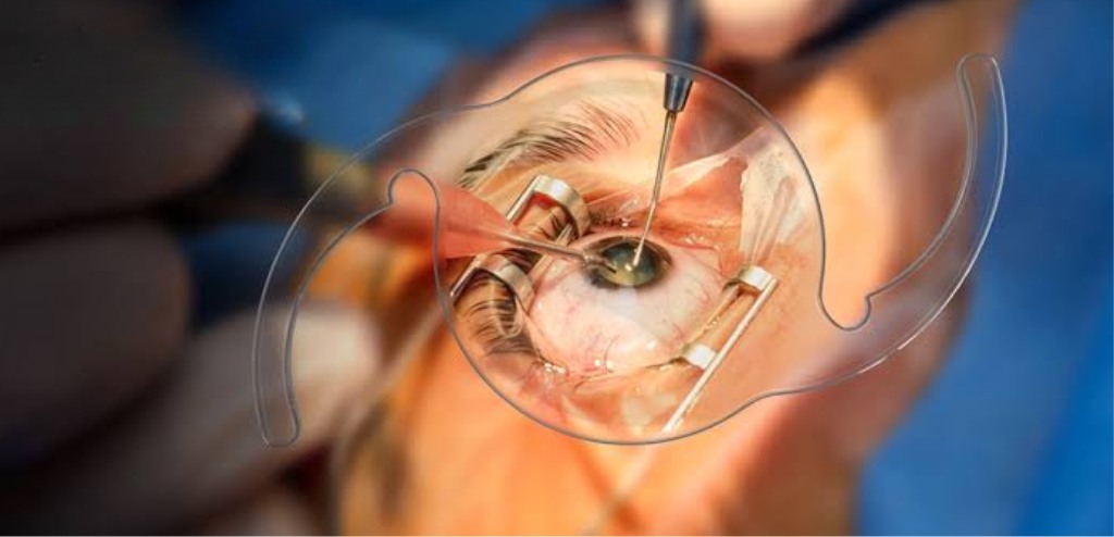 Varun Eye Care - Cataract Eye Surgery
